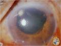 Imagen de ojo con glaucoma.