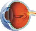 Imagen de ojo con Retinopatia Diabética.